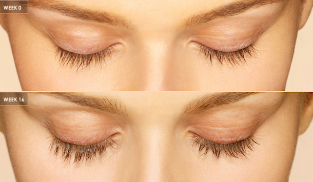 Latisse Before and After Eyelash Delaware