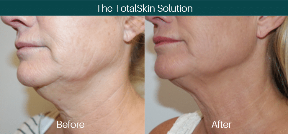 Totalskin before after