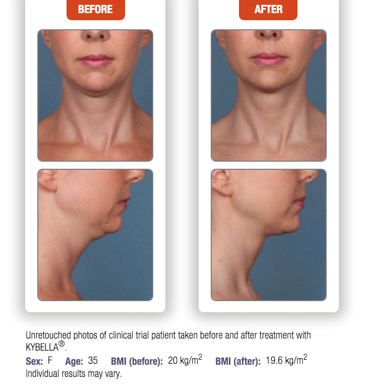 kybella before after female