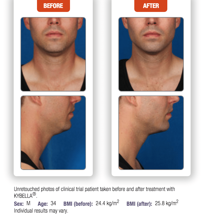 kybella before after male