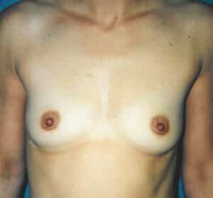 Breast Augmentation