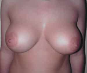 Breast Augmentation