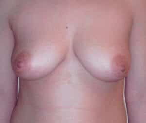 Breast Augmentation