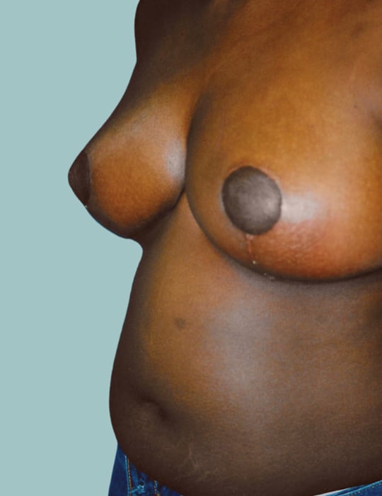 After Image: Breast Reduction - left-front-oblique