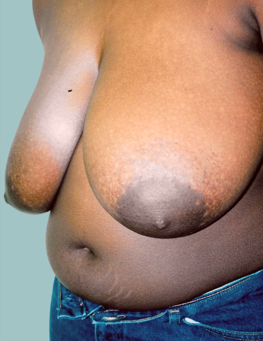 Before Image: Breast Reduction - left-front-oblique