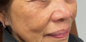 Facial Rejuvenation & Balancing