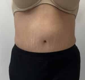 Tummy Tuck with Liposuction