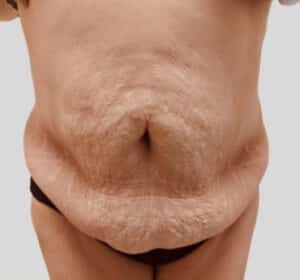 Tummy Tuck with Liposuction