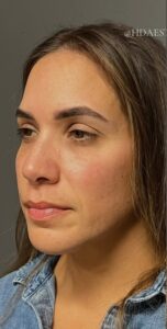 Before Image: Facial Rejuvenation & Balancing