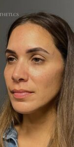 After Image: Facial Rejuvenation & Balancing