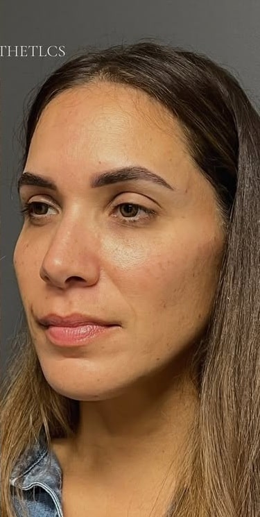 After Image: Facial Rejuvenation & Balancing - left-front-oblique