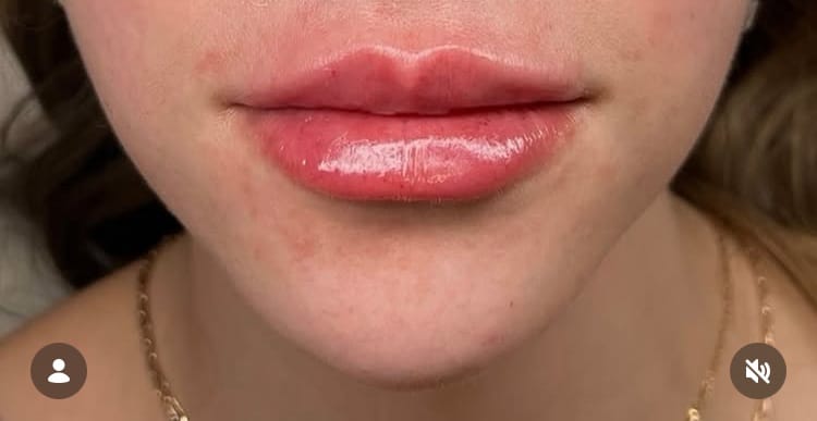 After Image: Lip Augmentation - front