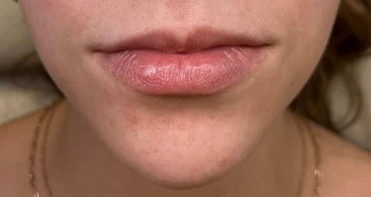Before Image: Lip Augmentation - front