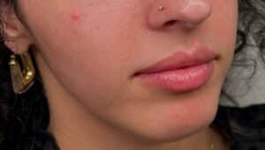 Before Image: Lip Augmentation