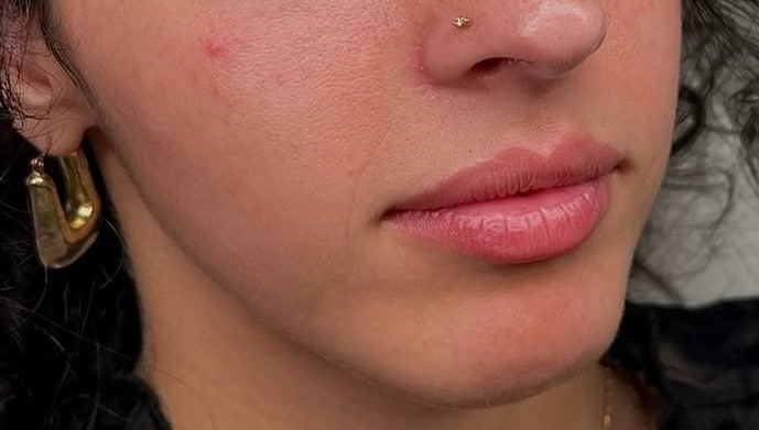 Before Image: Lip Augmentation - right-front-oblique