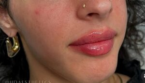 After Image: Lip Augmentation