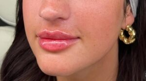 After Image: Lip Augmentation