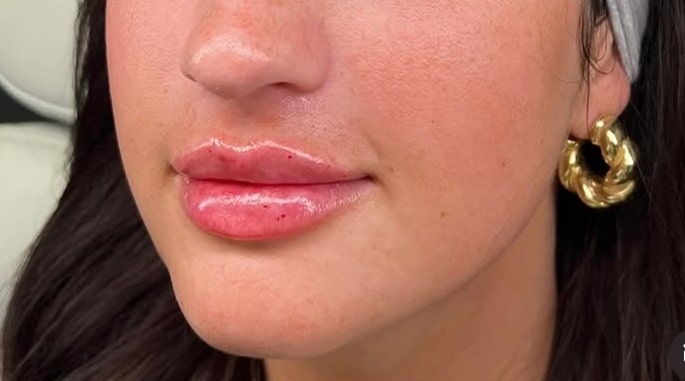 After Image: Lip Augmentation - left-front-oblique