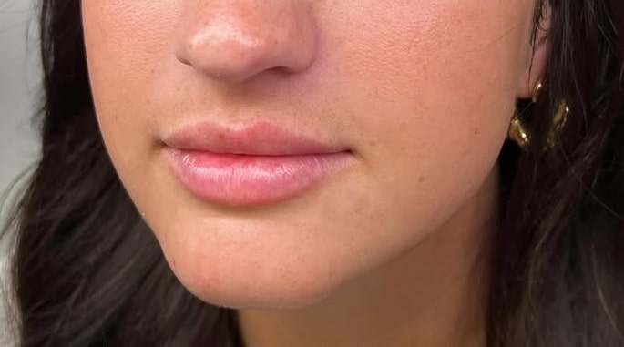 Before Image: Lip Augmentation - left-front-oblique