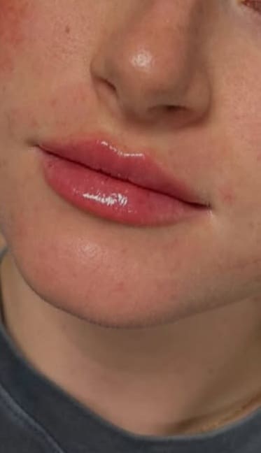 After Image: Lip Augmentation - front