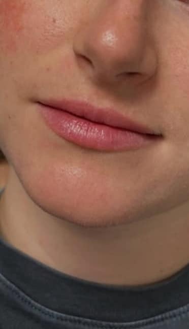 Before Image: Lip Augmentation - front