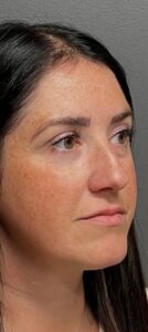 Before Image: Facial Rejuvenation & Balancing