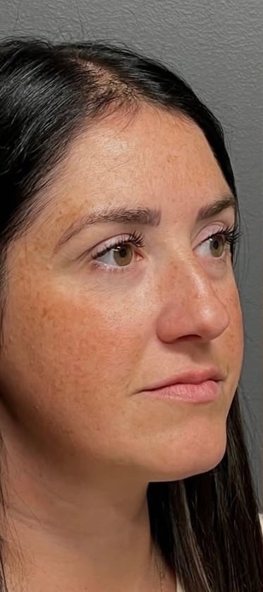 Before Image: Facial Rejuvenation & Balancing - right-front-oblique