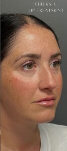 After Image: Facial Rejuvenation & Balancing