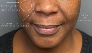 Before Image: Facial Rejuvenation & Balancing