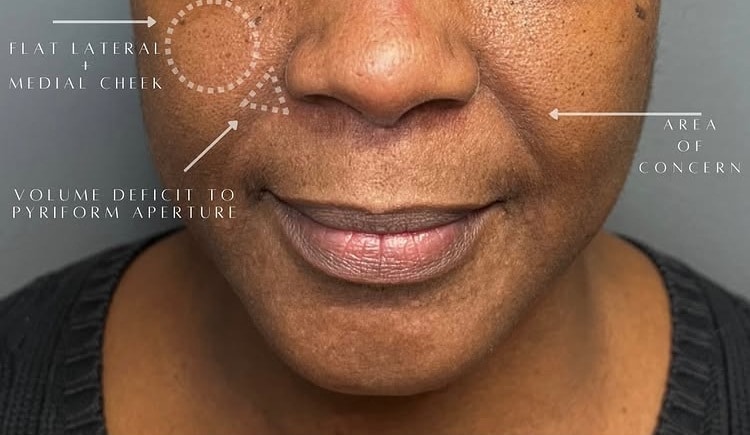 Before Image: Facial Rejuvenation & Balancing - front