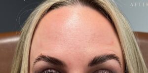 After Image: Wrinkle Treatments