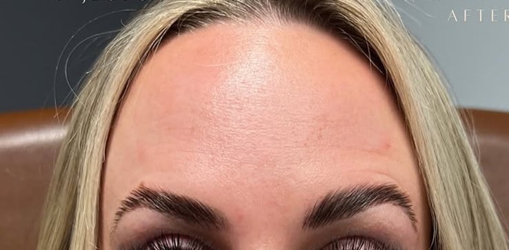 After Image: Wrinkle Treatments - front