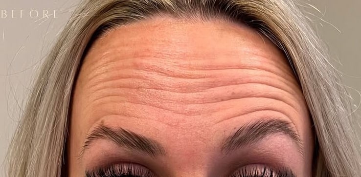 Before Image: Wrinkle Treatments - front