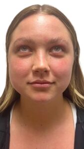 Before Image: Facial Rejuvenation & Balancing