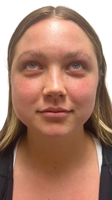 Before Image: Facial Rejuvenation & Balancing - front