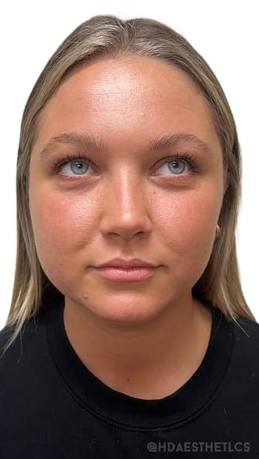 After Image: Facial Rejuvenation & Balancing - front