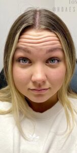 Before Image: Wrinkle Treatments