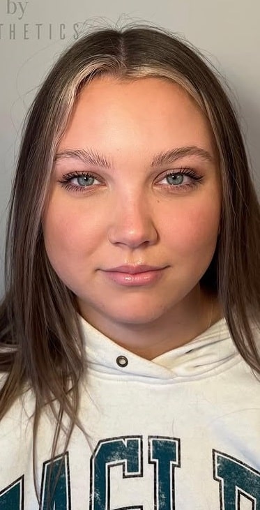 After Image: Wrinkle Treatments - front