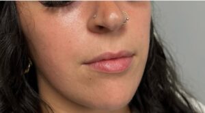 Before Image: Lip Augmentation