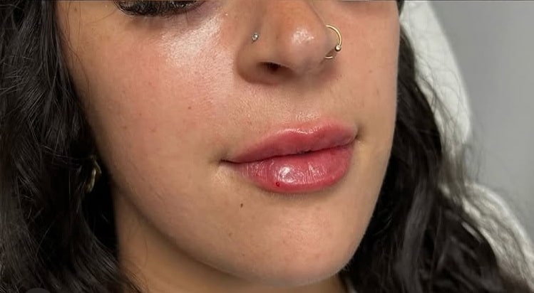 After Image: Lip Augmentation - front