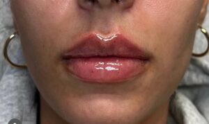 After Image: Lip Augmentation