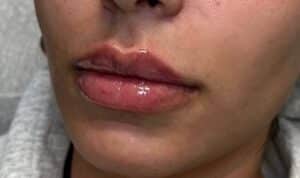 Before Image: Lip Augmentation