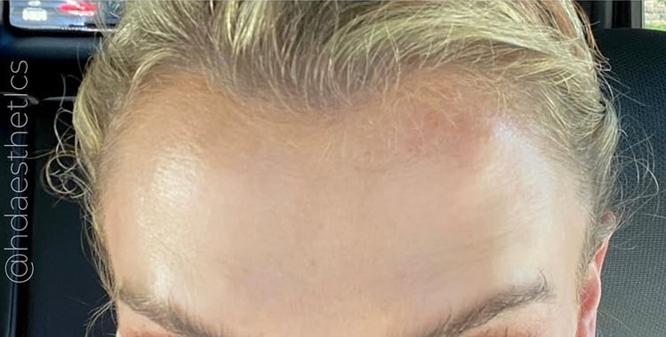 After Image: Wrinkle Treatments - front