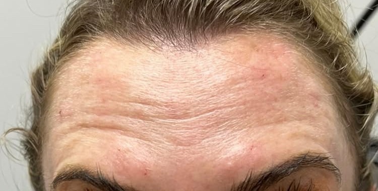 Before Image: Wrinkle Treatments - front